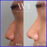 نتائج تجميل الأنف قبل وبعد في WillBe Plastic Surgery Clinic، تحسين شكل الأنف