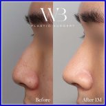 نتائج تجميل الأنف قبل وبعد في WillBe Plastic Surgery Clinic، تحسين شكل الأنف