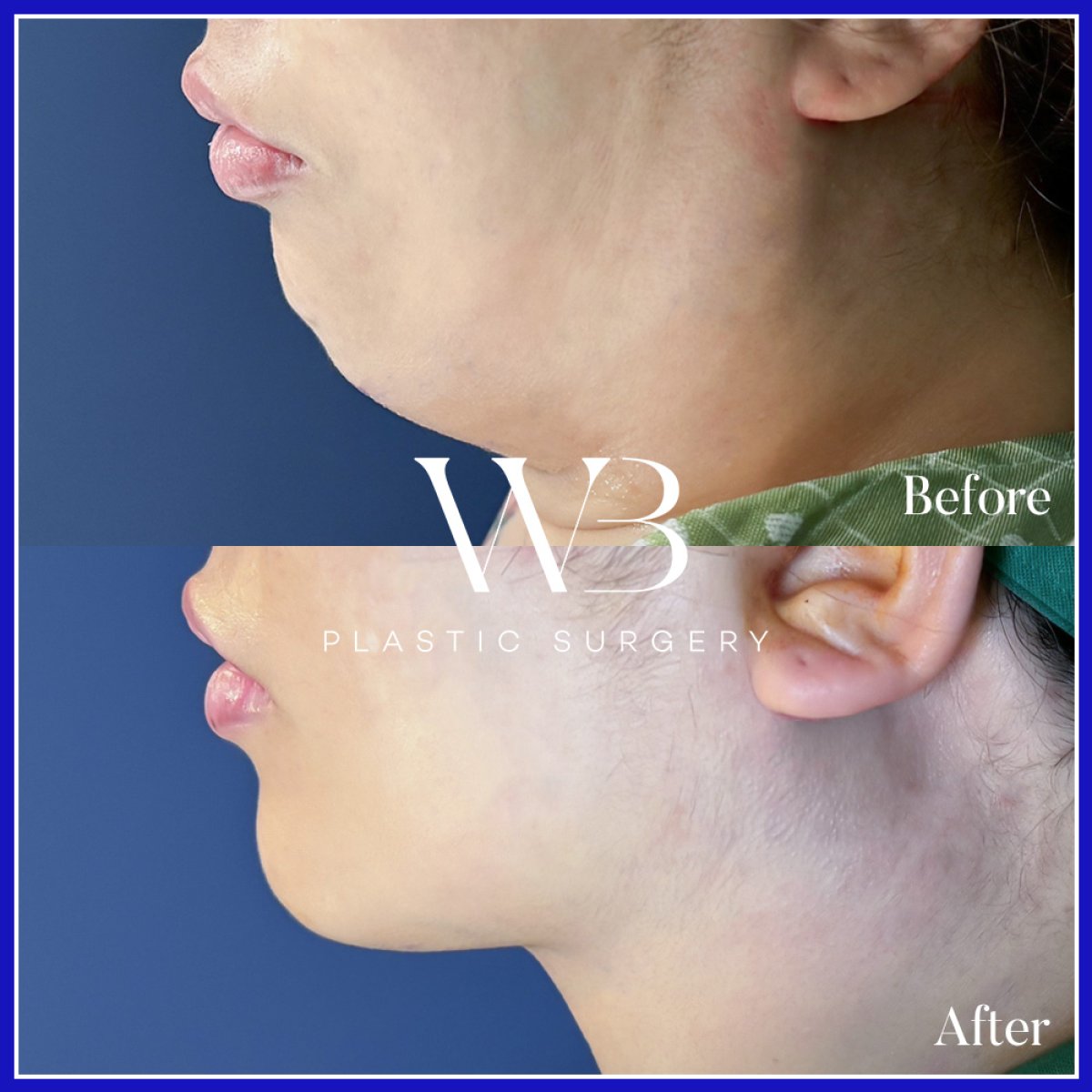Resultado de liposucción de papada antes y después en WillBe Plastic Surgery Clinic, mandíbula definida