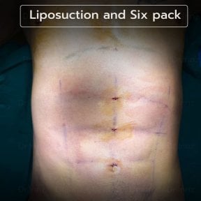 Liposuction and six pack result at Intrarat Hospital – defined abs after body contouring