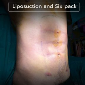 Liposuction and six pack result at Intrarat Hospital – defined abs after body contouring