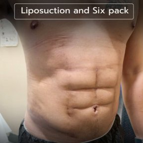 Liposuction and six pack result at Intrarat Hospital – defined abs after body contouring