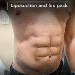 Liposuction and six pack result at Intrarat Hospital – defined abs after body contouring