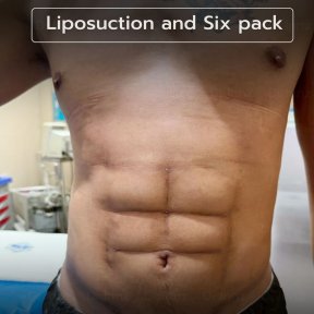 Liposuction and six pack abs result at Intrarat Hospital – defined abdominal contour
