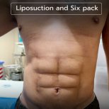 Liposuction and six pack abs result at Intrarat Hospital – defined abdominal contour