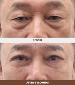 Результаты до и после фейслифтинга в Dr. Tak Plastic Surgery, омоложение области глаз