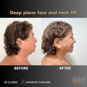 Before and after deep plane facelift and neck lift results at ID Clinic Bangkok