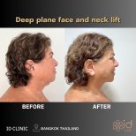 Before and after deep plane facelift and neck lift results at ID Clinic Bangkok