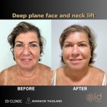 Before and after deep plane facelift and neck lift results at ID Clinic Bangkok