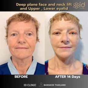 Before and after deep plane facelift and eyelid surgery results at ID Clinic Bangkok
