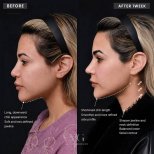 Vorher-nachher-Ergebnis Fadenlifting bei VG Plastic Surgery – verbesserte Kinn- und Kieferkontur