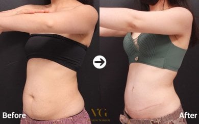 Before and after tummy tuck results at VG Plastic Surgery – visible abdominal contour improvement