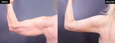 Before and after arm liposuction results at VG Plastic Surgery – improved arm contour visible