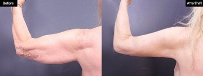 Before and after arm liposuction results at VG Plastic Surgery – improved arm contour visible