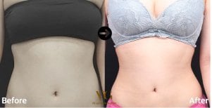 Before and after liposuction 3 body areas at VG Plastic Surgery, visible contouring result