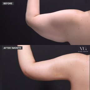 Before and after arm liposuction results at VG Plastic Surgery – improved arm contour visible