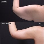 Before and after arm liposuction results at VG Plastic Surgery – improved arm contour visible