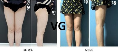 Before and after liposuction of 3 body areas at VG Plastic Surgery, visible slimmer legs result