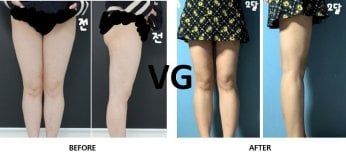 Before and after liposuction of 3 body areas at VG Plastic Surgery, visible slimmer legs result