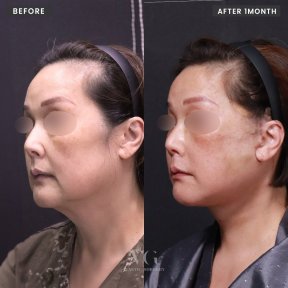 Résultats lifting visage avant/après chez VG Plastic Surgery, ovale du visage et cou raffermis
