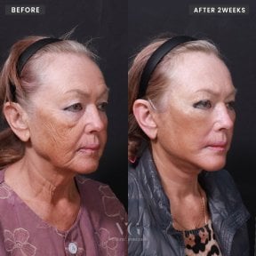 Facelift before and after results at VG Plastic Surgery – visible facial rejuvenation after 2 weeks