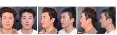 Before and after jawline contouring results at VG Plastic Surgery, improved facial definition