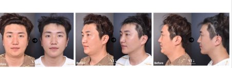 Before and after jawline contouring results at VG Plastic Surgery, improved facial definition