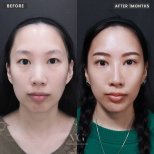 Before and after jawline contouring at VG Plastic Surgery, enhanced facial definition result