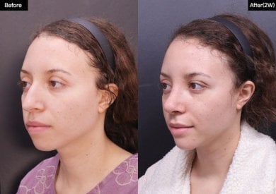Before and after rhinoplasty results at VG Plastic Surgery, improved nose shape and profile