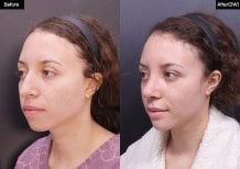 Before and after rhinoplasty results at VG Plastic Surgery, improved nose shape and profile