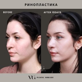 Before and after rhinoplasty results at VG Plastic Surgery, nose reshaping after 10 days