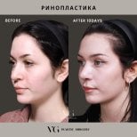 Before and after rhinoplasty results at VG Plastic Surgery, nose reshaping after 10 days