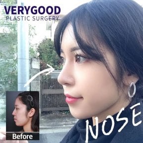 Before and after rhinoplasty results at VG Plastic Surgery, improved nose profile and contour