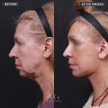 Facelift before and after results at VG Plastic Surgery – visible facial rejuvenation after 2 weeks