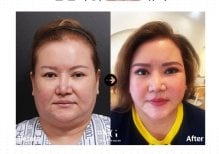 Facelift before and after results at VG Plastic Surgery – visible facial rejuvenation and contour