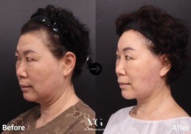 Before and after facelift results at VG Plastic Surgery – visible facial rejuvenation and lift