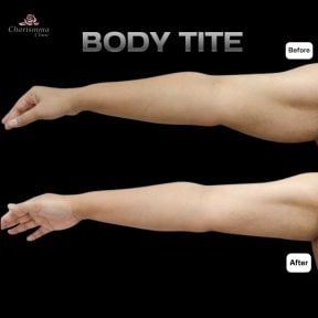 Before and after BodyTite arm contouring results at Charismma Clinic, visible skin tightening