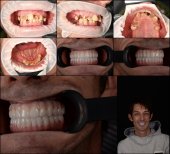 Résultats avant et après implants dentaires à la RIKOTA Dental Clinic – sourire restauré