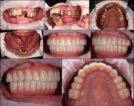 Résultats avant et après implants dentaires à la RIKOTA Dental Clinic – restauration complète du sourire