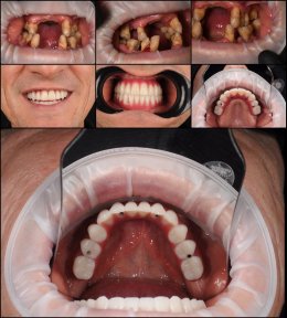 Résultats avant/après implants dentaires à la RIKOTA Dental Clinic – restauration du sourire