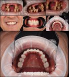 Résultats avant/après implants dentaires à la RIKOTA Dental Clinic – restauration du sourire
