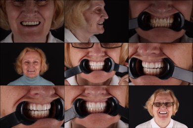 Résultats avant/après implants dentaires à RIKOTA Dental Clinic – sourire restauré