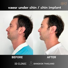 Before and after chin implant results at ID Clinic Bangkok, improved chin contour visible