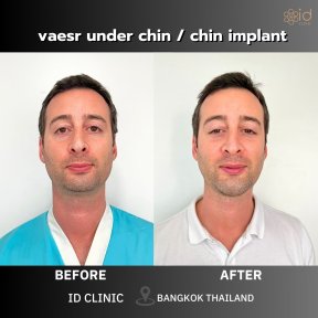 Before and after chin implant results at ID Clinic Bangkok, improved chin contour visible