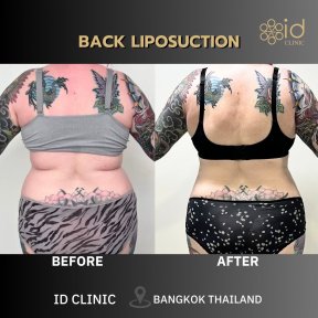 Resultados de liposucción de espalda antes y después en ID Clinic Bangkok, reducción visible