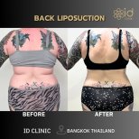 Resultados de liposucción de espalda antes y después en ID Clinic Bangkok, reducción visible