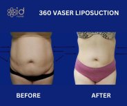Resultados antes y después de liposucción 360 VASER en ID Clinic Bangkok, cintura más delgada