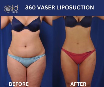 Resultados antes y después de liposucción 360 VASER en ID Clinic Bangkok, mejora corporal