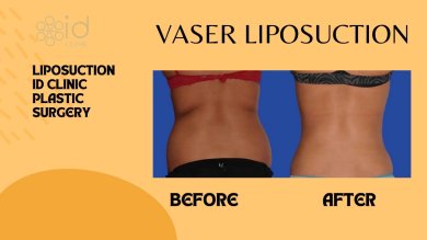 Resultados antes y después de liposucción VASER en ID Clinic Bangkok, contorno de cintura visible