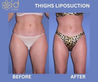 Resultados de liposucción de muslos antes y después en ID Clinic Bangkok, muslos más delgados